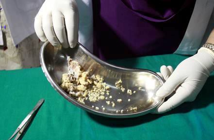 India: Un ragazzo indiano con 232 denti article-post