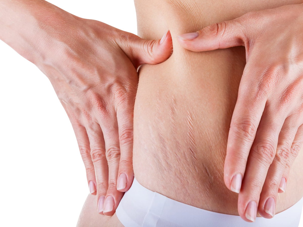Smagliature: quali sono le cause e come prevenirle article-post