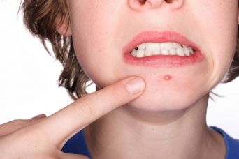 L’acne: dermatosi infiammatoria article-post