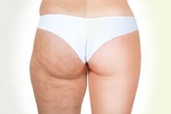 Cellulite: un inestetismo difficile da eliminare article-post