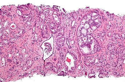 Tumore alla prostata: un appuntamento per prevenirlo. article-post