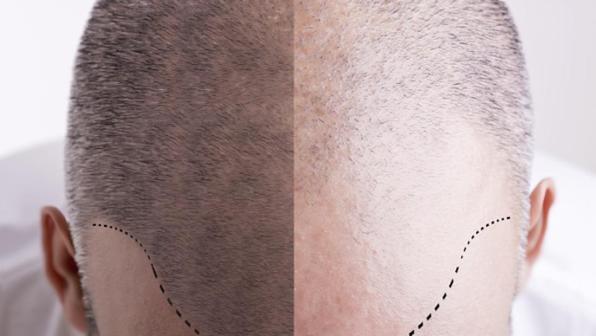 Trapianto capelli in Turchia: è una cura della calvizia? article-post