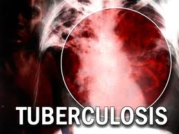 Allarme tubercolosi: due pazienti infetti scappano dall’ospedale Gemelli di Roma article-post