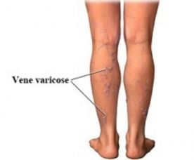 Le vene varicose: disturbo presente in molte donne article-post