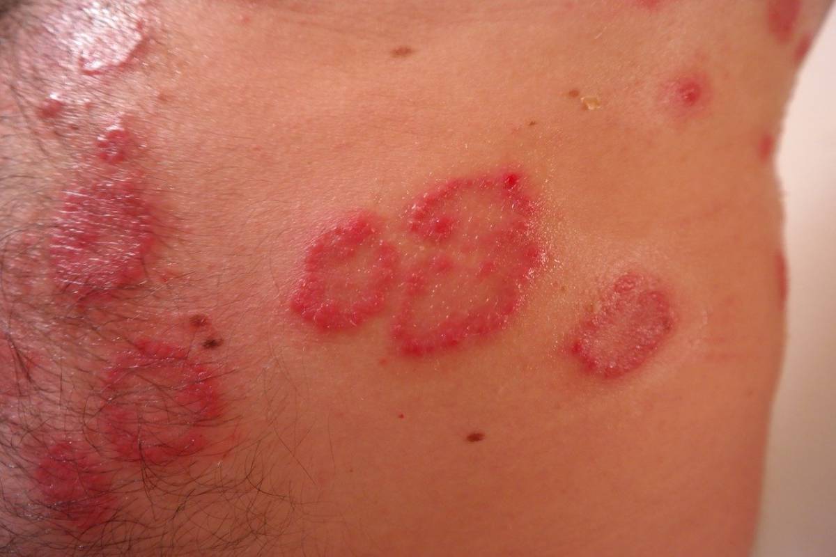 Coronavirus: si manifesta anche con macchie sulla pelle. Ecco la scoperta article-post