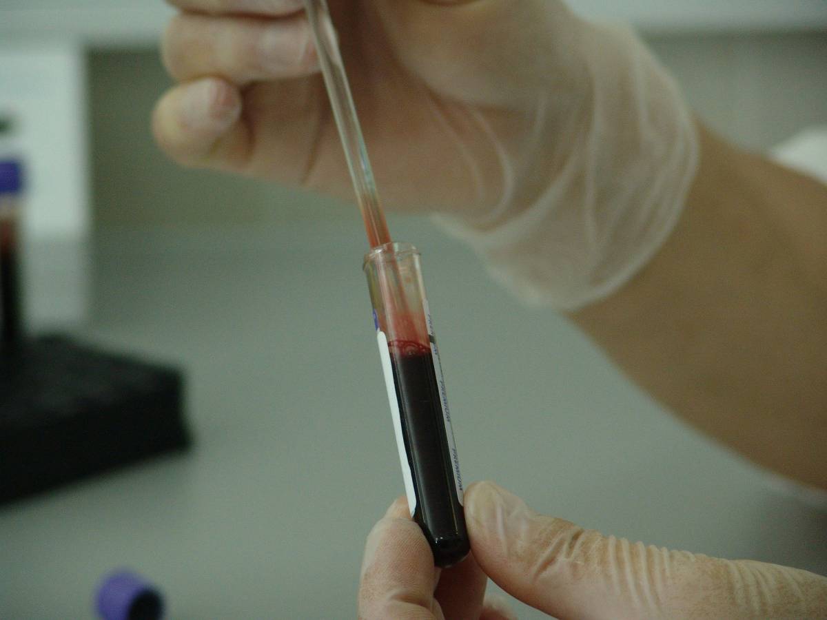 Il coronavirus potrebbe produrre autoanticorpi come il Lupus article-post