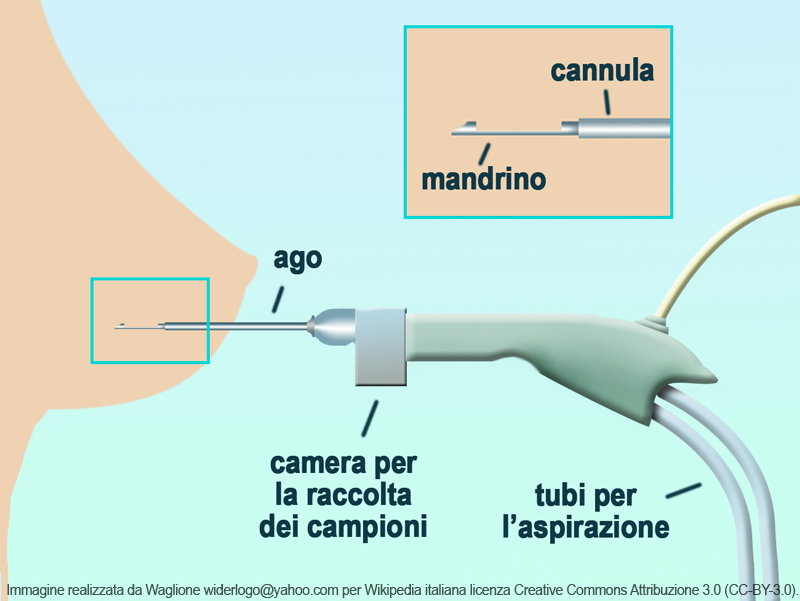 Mammotome: cos’è e a cosa serve l’agobiopsia mammaria article-post