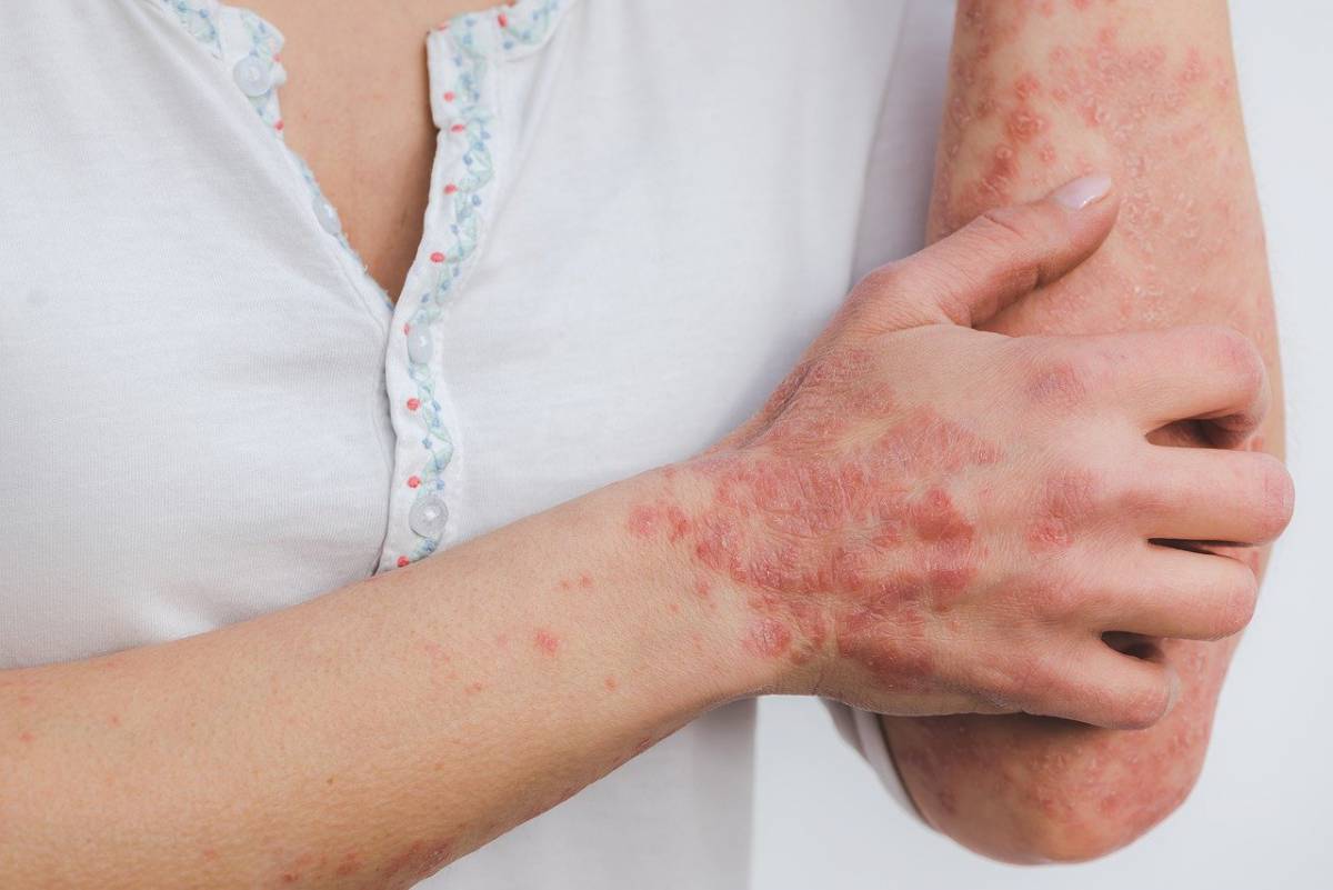 Psoriasi: trovato un nuovo farmaco che potrebbe curarla article-post