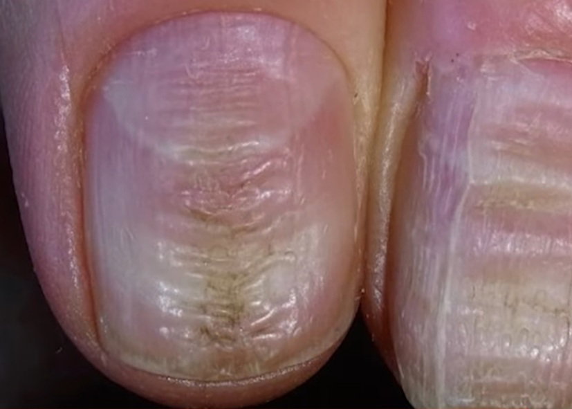 Unghie e covid o Covid Nails: rimangono segnali dell’infezione anche su di loro article-post