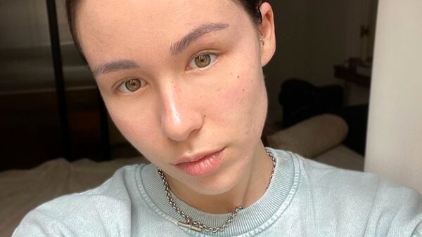 Acne, la battaglia condivisa di Aurora Ramazzotti article-post