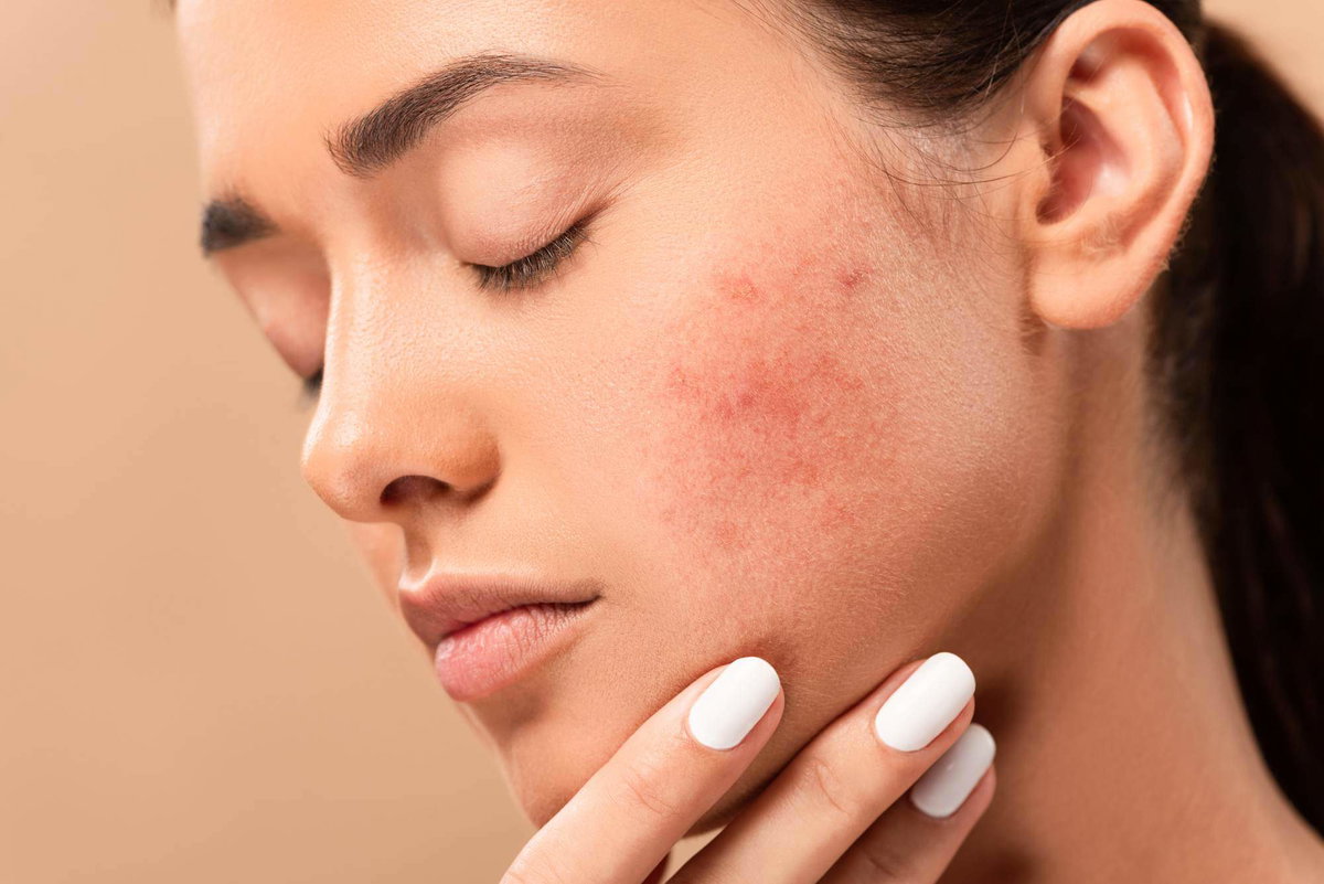 Acne: I migliori cibi per ridurre il problema article-post