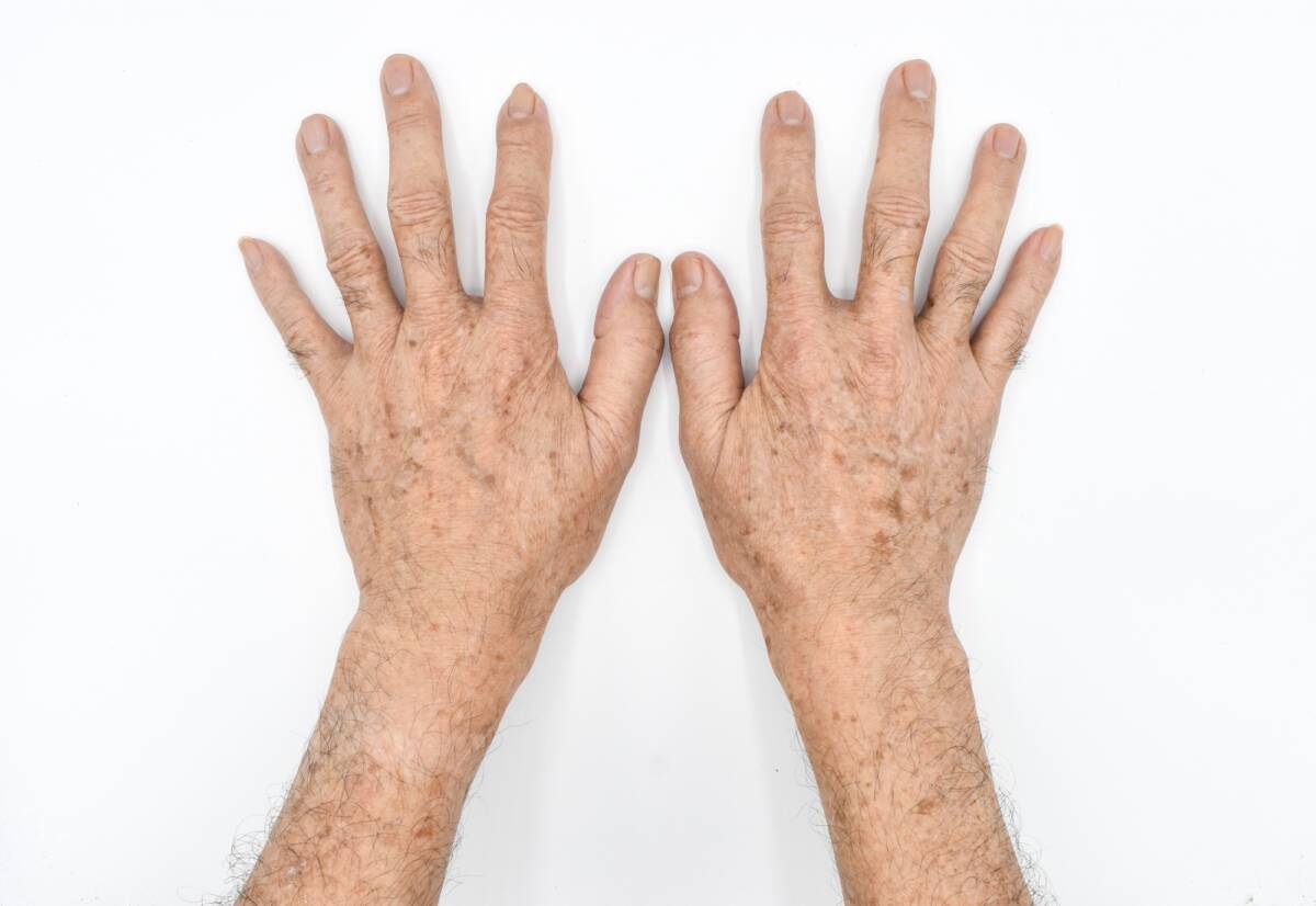 Macchie sulle mani: cosa sono, perché vengono, come curarle con questo olio article-post