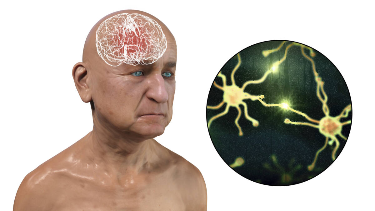 Gene CHRFAM7A: ecco l’alleato contro Alzheimer e Parkinson. Pubblicato nuovo studio article-post