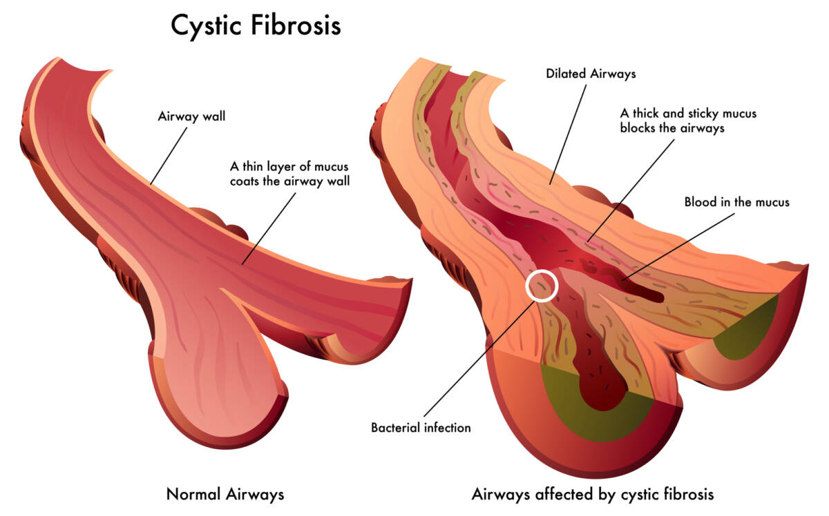 Fibrosi cistica: una combinazione di tre molecole efficace per il 75% dei pazienti article-post