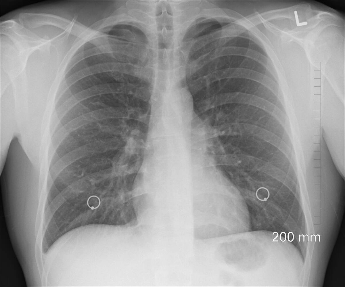 Nuova cura contro il carcinoma polmonare non a piccole dosi: ridotta la progressione grazie ad un nuovo farmaco anticorpo article-post