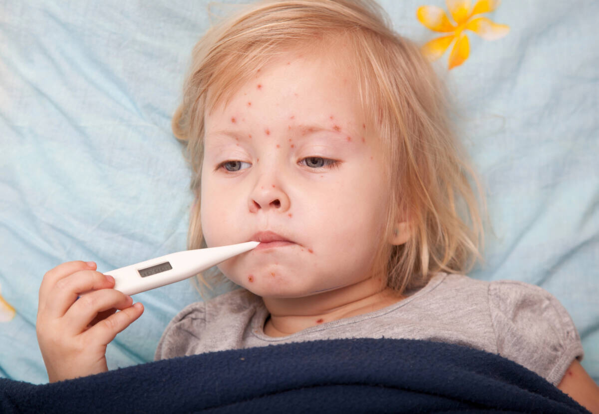 Boom di casi di morbillo in Italia: quando effettuare il test sierologico article-post