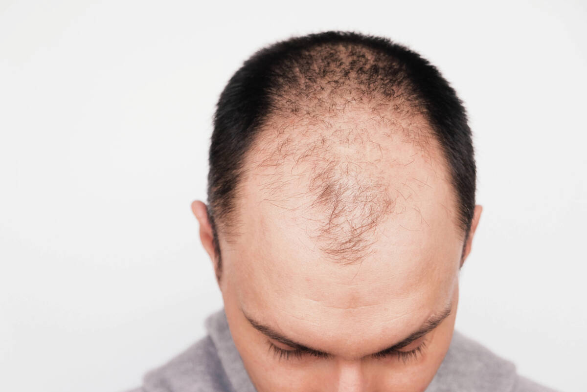 Addio calvizia: la scoperta di un legame tra lo zucchero e crescita dei capelli article-post