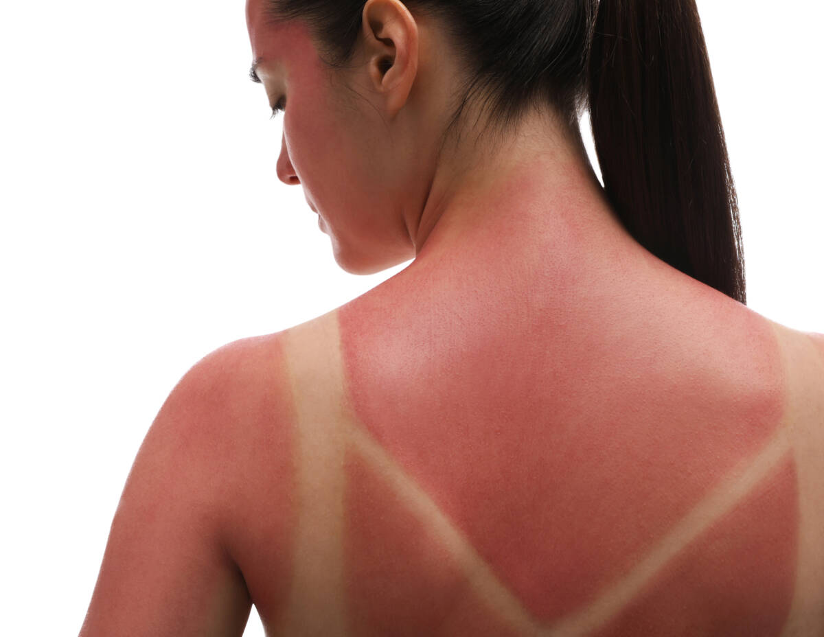 Pelle bruciata dal sole? Prova questi rimedi efficaci e rapidi article-post