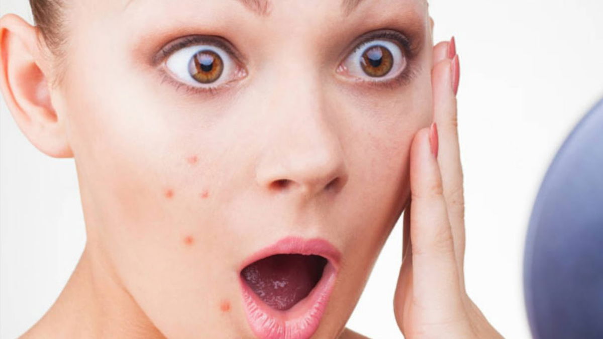 L’acne sul tuo corpo parla del tuo stato di salute article-post